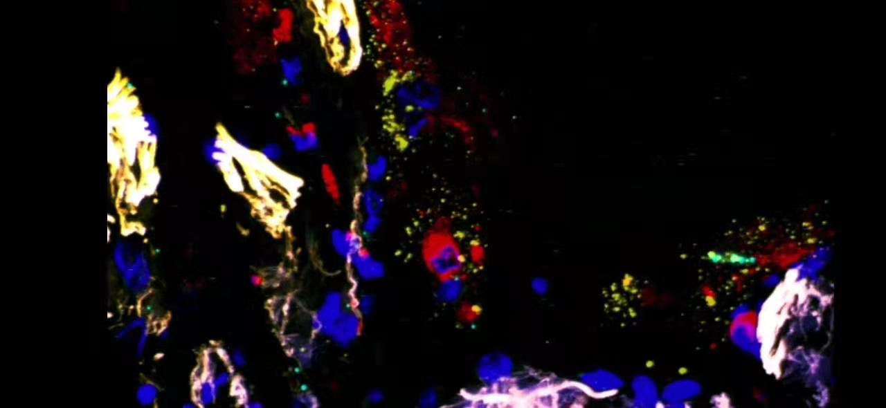 Circuits between infected macrophages and T cells in SARS-CoV-2 pneumonia Circuits between infected macrophages and T cells in SARS-CoV-2 pneumonia