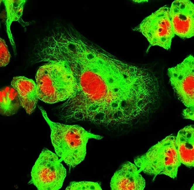 人類(lèi)神經(jīng)母細(xì)胞瘤細(xì)胞的熒光顯微圖 人類(lèi)神經(jīng)母細(xì)胞瘤細(xì)胞的熒光顯微圖